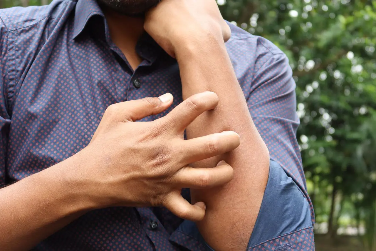 Studio Novartis, l’orticaria cronica spontanea costa 4.200 euro l’anno a paziente